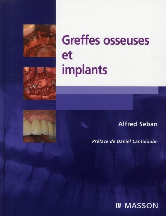 Emprunter Greffes osseuses et implants livre