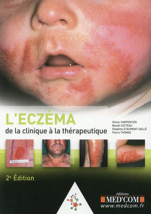 Emprunter L'eczéma. De la clinique à la thérapeutique, 2e édition livre